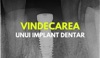 Cat de mult dureaza vindecarea dupa un implant dentar?